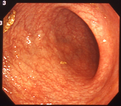 正常な大腸