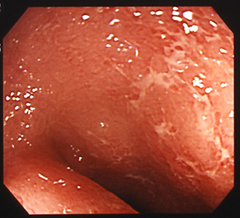 軽症の潰瘍性大腸炎