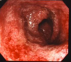 中等症の潰瘍性大腸炎