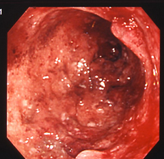 重症の潰瘍性大腸炎