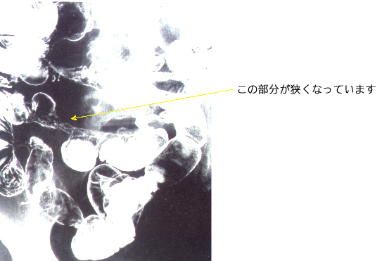 腸閉塞の例